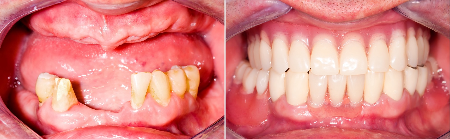 Full Mouth Rehabilitation